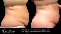 Sculpsure Laser Fat Removal is a laser-based, non-invasive treatment that’s used to target Laser Fat Removal. Non-invasive, nonsurgical cosmetic body procedures are becoming increasingly popular, especially to help with fat reduction. For more infor...